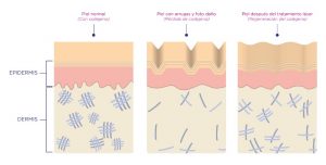 rejuvenecimiento facial con láser fraccionado